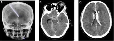 Extracorporeal membrane oxygenation for acute pulmonary embolism after postoperative craniocerebral trauma: a case report